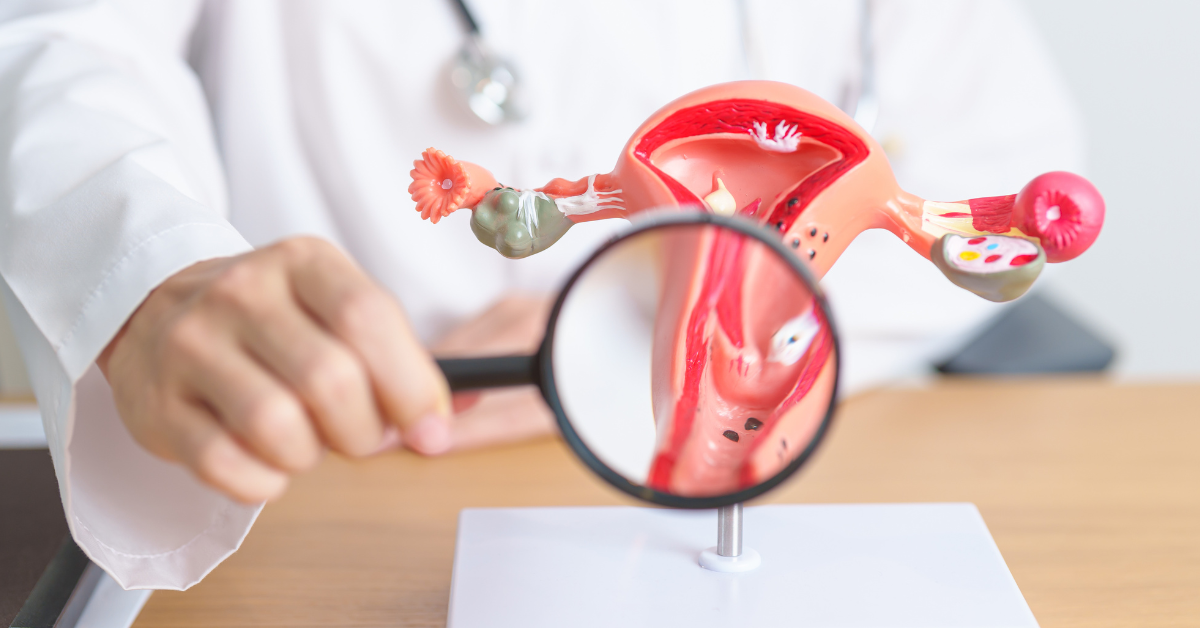 A doctor holds a magnifying glass to a diagram of a uterus to illuminate Poly Cystic Ovarian Syndrome (PCOS). 